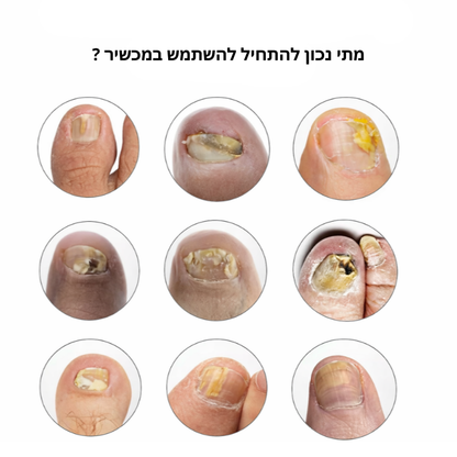 טיפול לייזר בפטרת הציפורניים