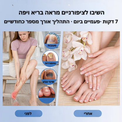 טיפול לייזר בפטרת הציפורניים