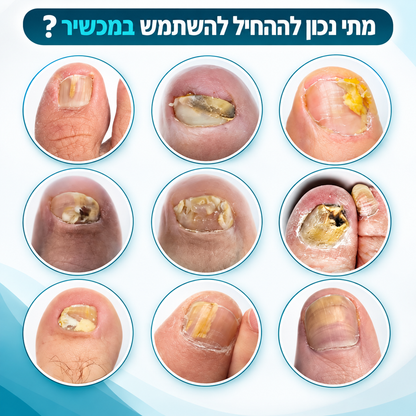 טיפול לייזר בפטרת הציפורניים